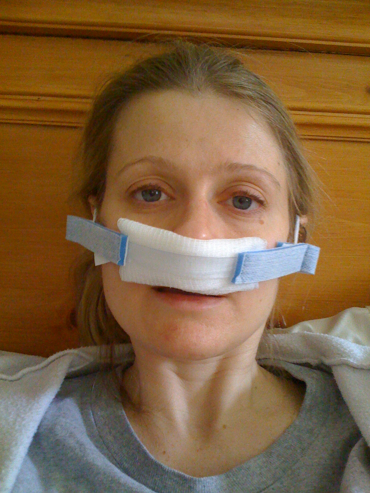 deviated septum surgery | My Real Life